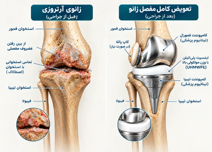 تعویض مفصل زانو