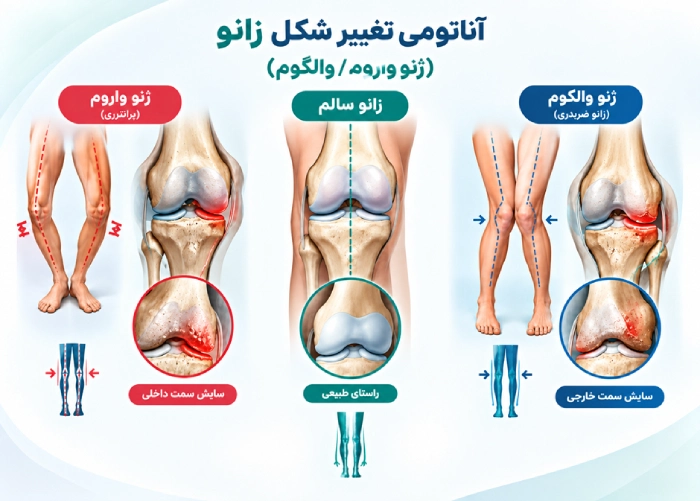 تغییر شکل زانو