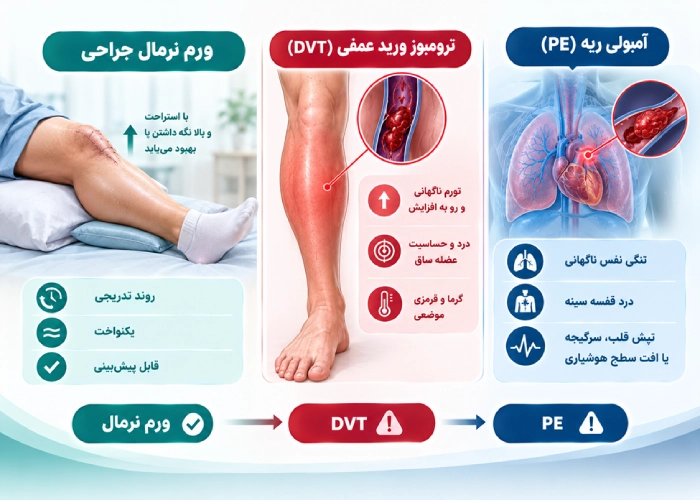 DVT