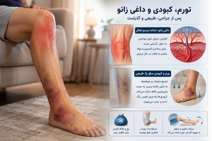 تورم شدید