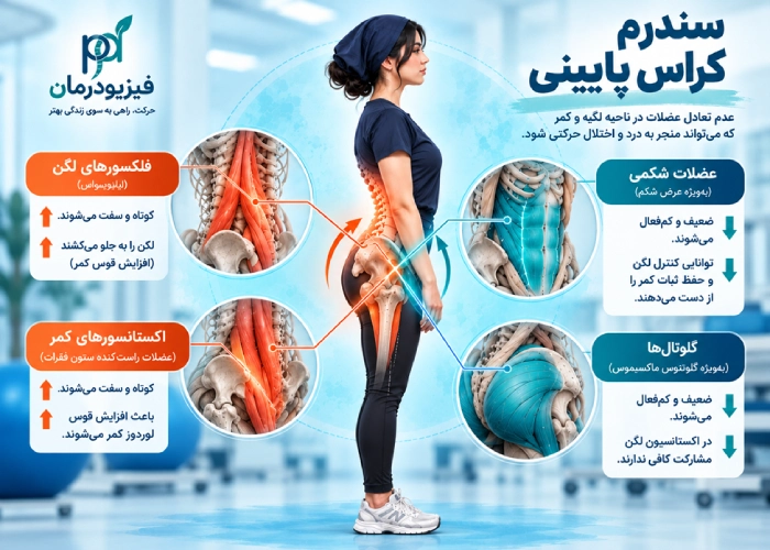 سندرم کراس پایینی
