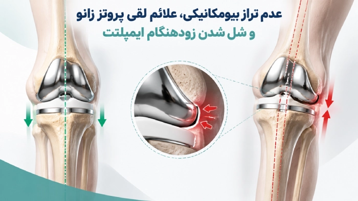 عدم تراز بیومکانیکی